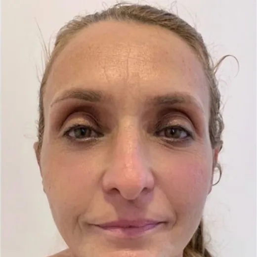 Depois — Harmonização Facial